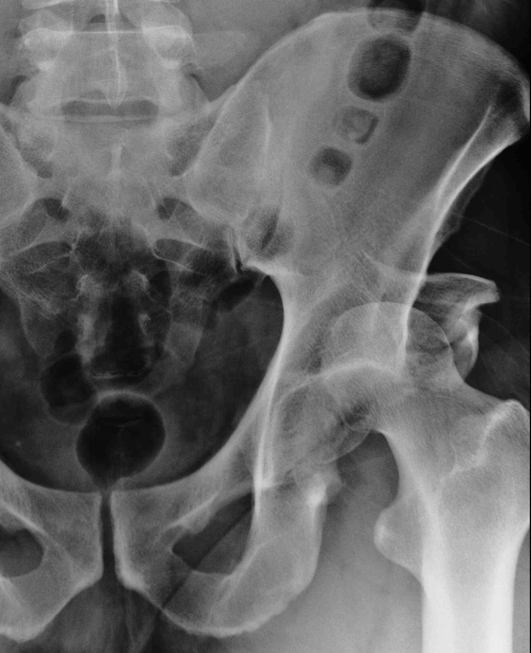Hip Dislocation Posterior Wall Fracture